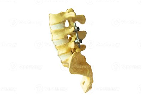 lombaire colonne vertébrale modèle avec instrument fixation. 22274681 ...