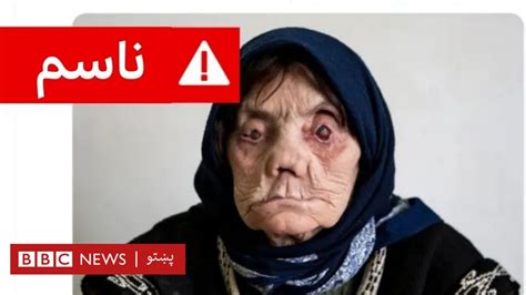 ایا افغان کډوال په ایران کې د جذام ناروغۍ د خپرېدو لامل دي؟ Bbc News پښتو