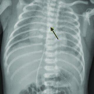 The umbilical venous catheter tip (arrow) remain ed inside the cardiac ...