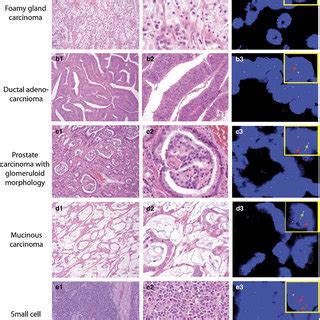 H E Staining And Corresponding FISH Images Of ERG Rearrangement In