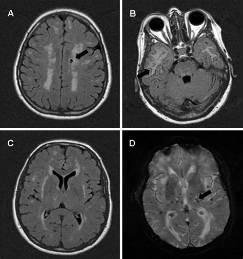 CADASIL causes, symptoms, diagnosis, treatment & prognosis