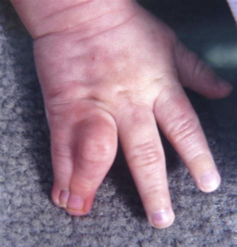 Complex Syndactyly Aesthetic And Objective Outcomes Journal Of Hand