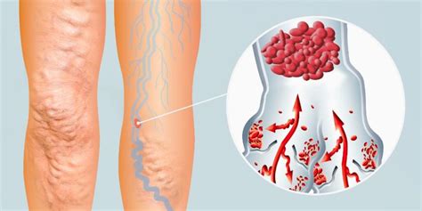 Universal Energía Hambruna Flebitis Y Tromboflebitis De Vasos Superficiales De Los Miembros