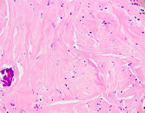 Pathology Outlines Calcifying Fibrous Tumor