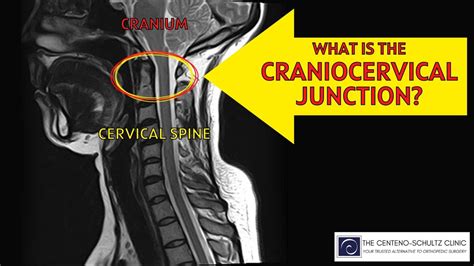 What Is The Craniocervical Junction CSC