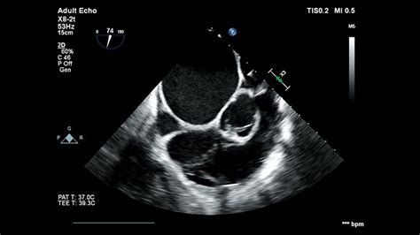 3d Ultrasound Of The Heart