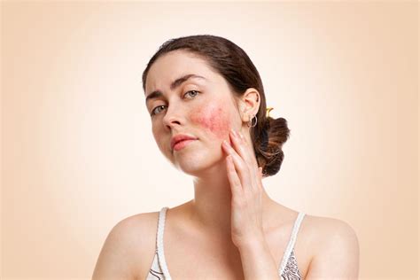 Rosacea Symptome Behandlung