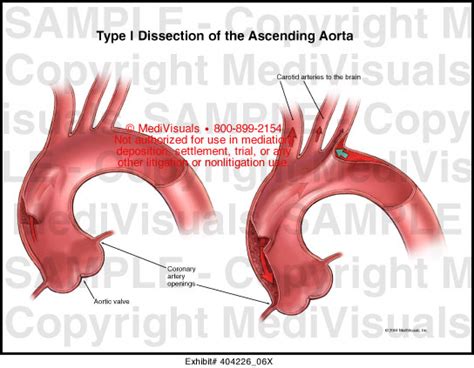 Type I Dissection Of The Ascending Aorta Medical Exhibit Medivisuals