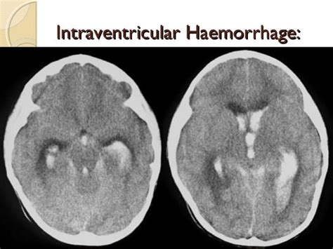 5 Unique Ways Doctors Diagnose Spina Bifida Hydrocephalus