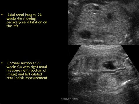 10 Fetal Urinary Tract Dr Ahmed Esawy