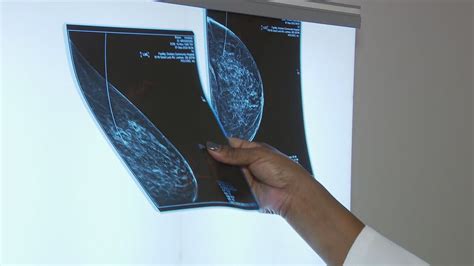 Fda To Finalize Language To Notify Women About Their Breast Density By