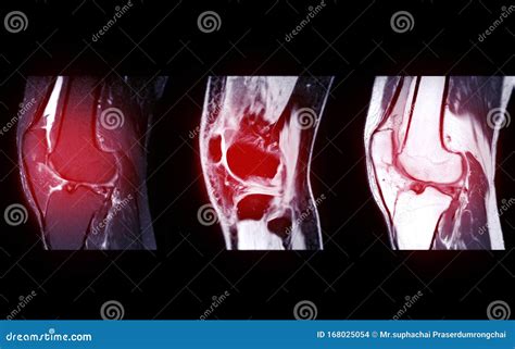 Compare Of Mri Knee Joint Or Magnetic Resonance Imaging Sagital View