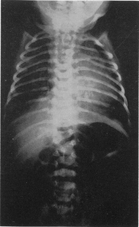 Tracheoesophageal Fistula Unassociated With Atresia Or Stenosis