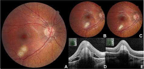 Presumed Ocular Histoplasmosis With Choroidal Neovascularization In A