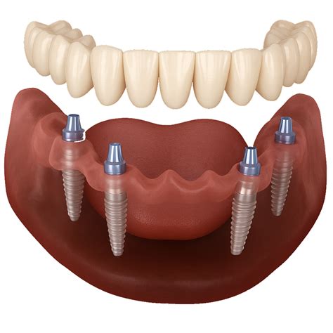 All On 4 Dental Implants In Paramus Nj Nj Implant Dentist