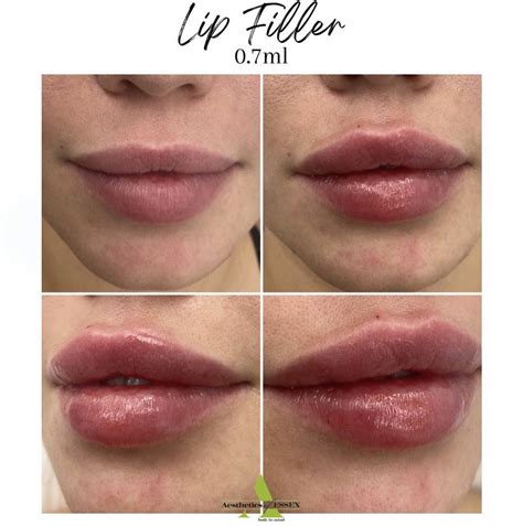 Lip Fillers Essex Dermal Fillers Essex Aesthetics Of Essex