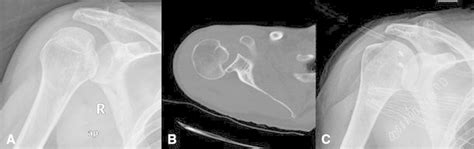 Anteroposterior Radiograph And B Axial Ct Scan Of The Right Shoulder Of Download Scientific