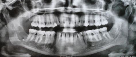 Orthopantomography Performed At The First Visit Showing An Unilocular