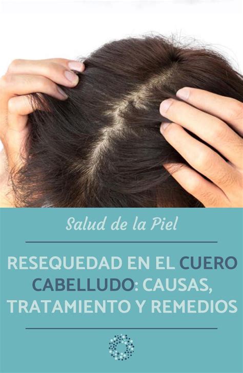 Resequedad En El Cuero Cabelludo Causas Tratamiento Y Remedios