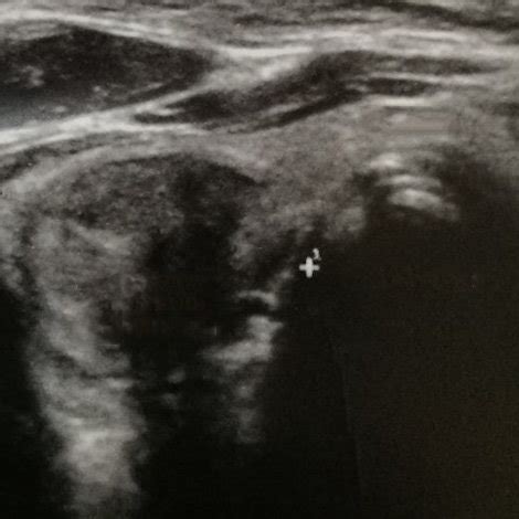 Ultrasound image of parathyroid adenoma. | Download Scientific Diagram