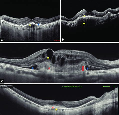 Choroidal Neovascular Membrane Oct