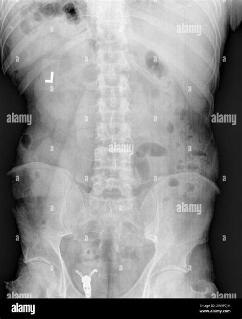 Film X Ray Or Radiograph Of A Normal Adult Lumbar Vertebrae Anterior