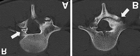 Axial Computed Tomography Scans Showing Bilateral Spondylolysis Of L5 Download Scientific