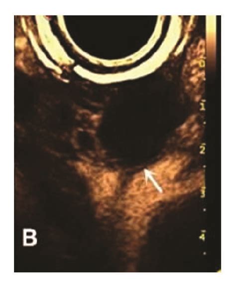 Chocolate cyst. (a) Image showing hypoechoic lesion (arrow). (b ...