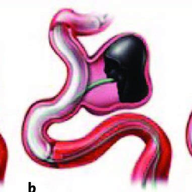 scheme   deposition  liquid embolic agent onyx