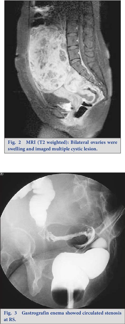 Figure 3 From A Case Of Juvenile Rectosigmoid Signet Ring Cell Carcinoma Found Due To A