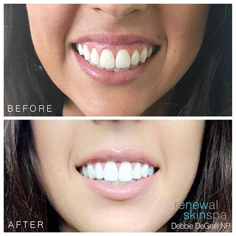 Lip Flip Before And After Smile