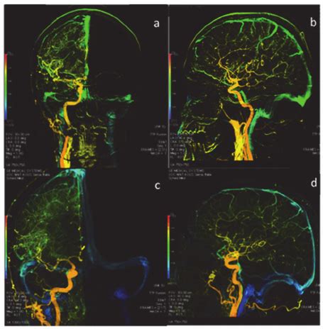 DSA Examination Anterior Posterior And Lateral Views Of Color Coded