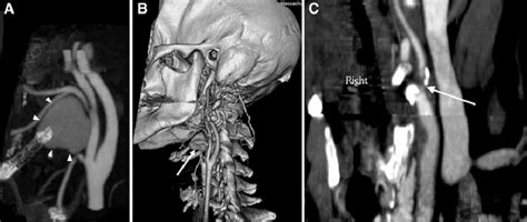 Ct Angiography Of Normal And Abnormal Carotid Arteries A Thick Slab