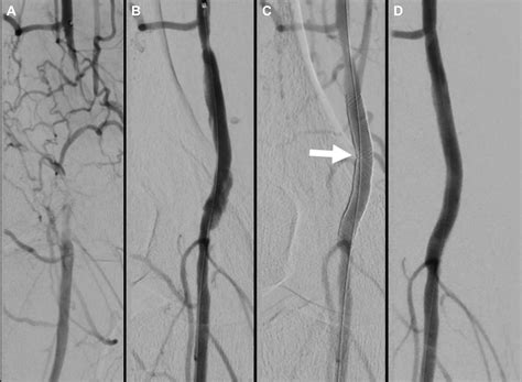 Endovascular Treatment Of Popliteal Artery Occlusion Caused By A