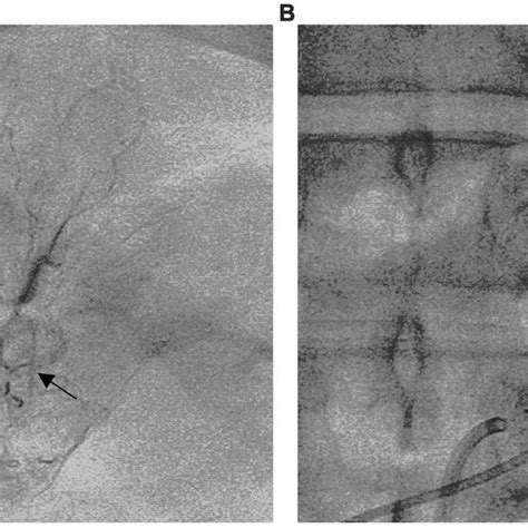 The Effects Of Superselective Adrenal Arterial Embolization SAAE