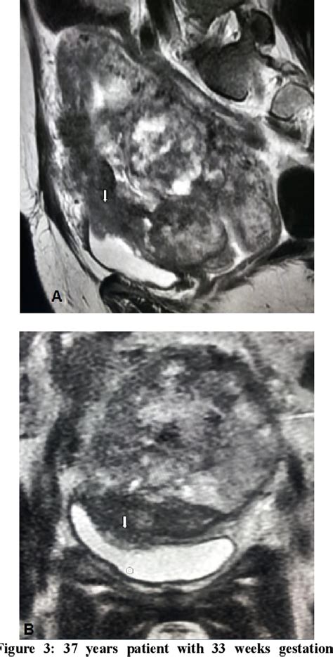 Figure From Role Of Mri In Diagnosis Of Placenta Accreta Semantic