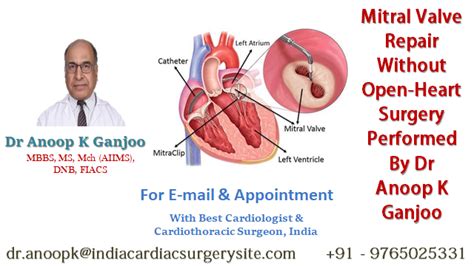 Mitral Valve Repair Without Open Heart Surgery Performed By Dr Anoop K