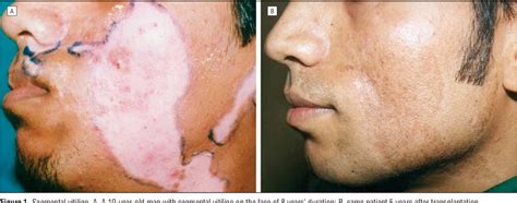 Focal Vitiligo