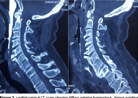 Figure 1 From Dysphagia Revealing Diffuse Idiopathic Skeletal Hyperostosis Report Of Two Cases