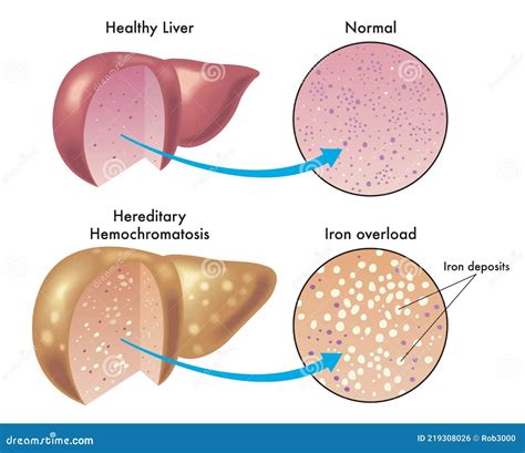 Hemochromatosis Or Iron Overload. Healthy Liver And Liver With Iron ...