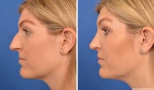 Rhinoplasty Beverly Hills Nose Surgery Beverly Hills