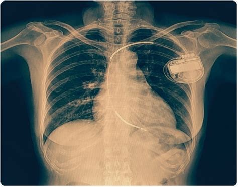 Are wearable defibrillators a suitable alternative to surgically ...