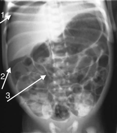 How To Use Abdominal X Rays In Preterm Infants Suspected Of Developing