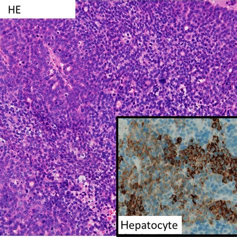 Histopathology showing a poorly differentiated hepatocellular carcinoma... | Download Scientific ...