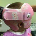 Cranial Helmets – EastPoint Prosthetics & Orthotics