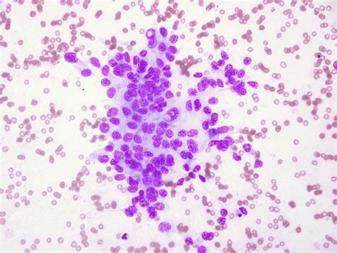 Pathology Outlines Cribriform Morular Thyroid Carcinoma