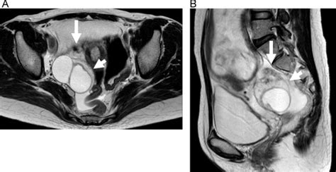 MRI scan showing torsion of the right ovary with a corpus luteum cyst... | Download Scientific ...