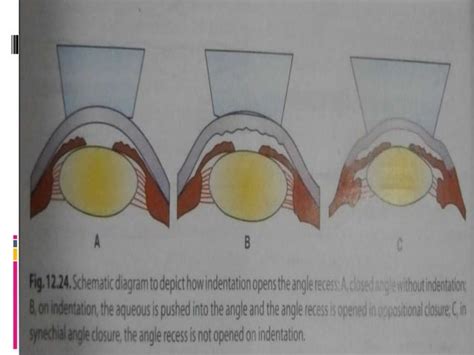 Gonioscopy Gonioscopic Lenses Principle And Clinical Aspects Ppt