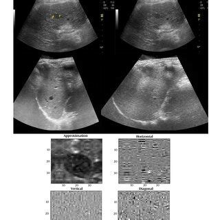 (PDF) Hepatocellular Carcinoma Diagnosis Based on Ultrasound Images Using Feature Selection ...