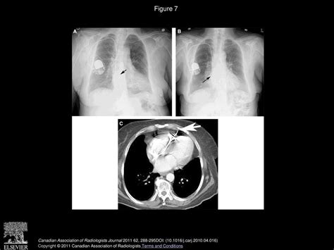 Chest Radiographs Are Valuable In Demonstrating Clinically Significant